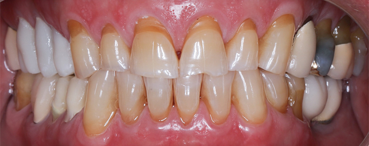 NuVeneers<sup>®</sup> Before & After Photo