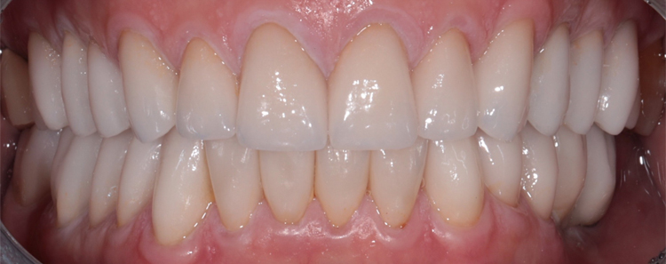NuVeneers<sup>®</sup> Before & After Photo