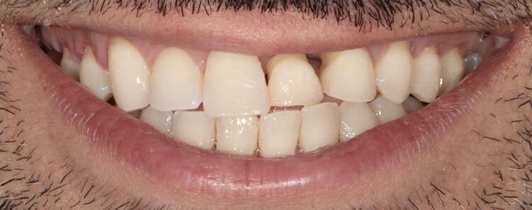 NuVeneers<sup>®</sup> Before & After Photo
