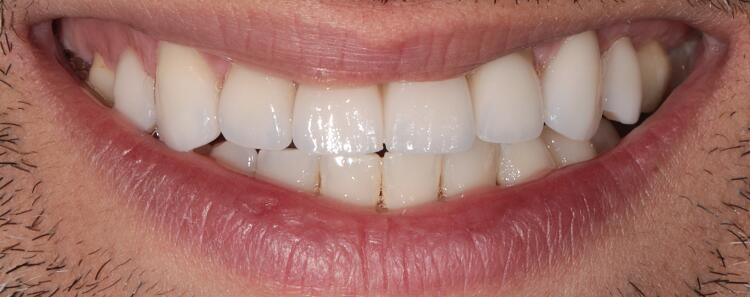 NuVeneers<sup>®</sup> Before & After Photo
