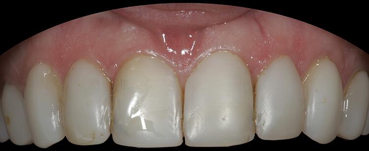 Before & After Photo