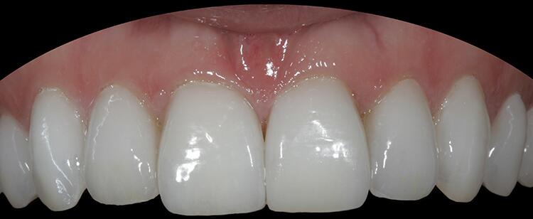 Before & After Photo