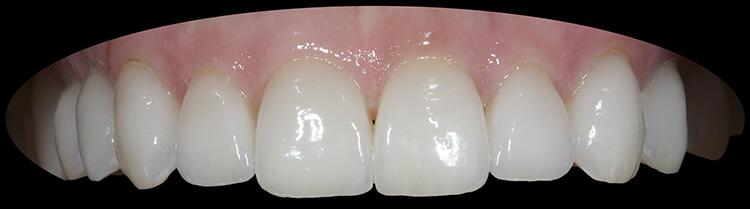 Before & After Photo