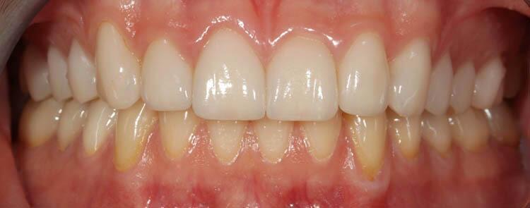 Before & After Photo