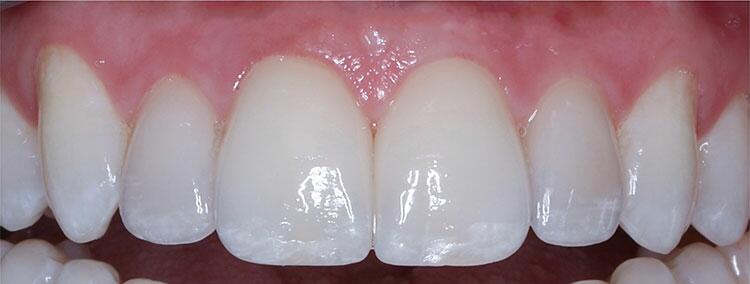 Before & After Photo