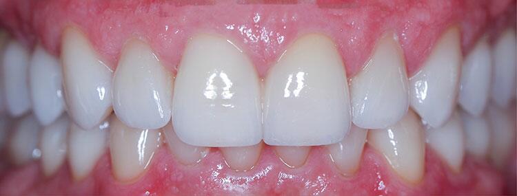 Before & After Photo